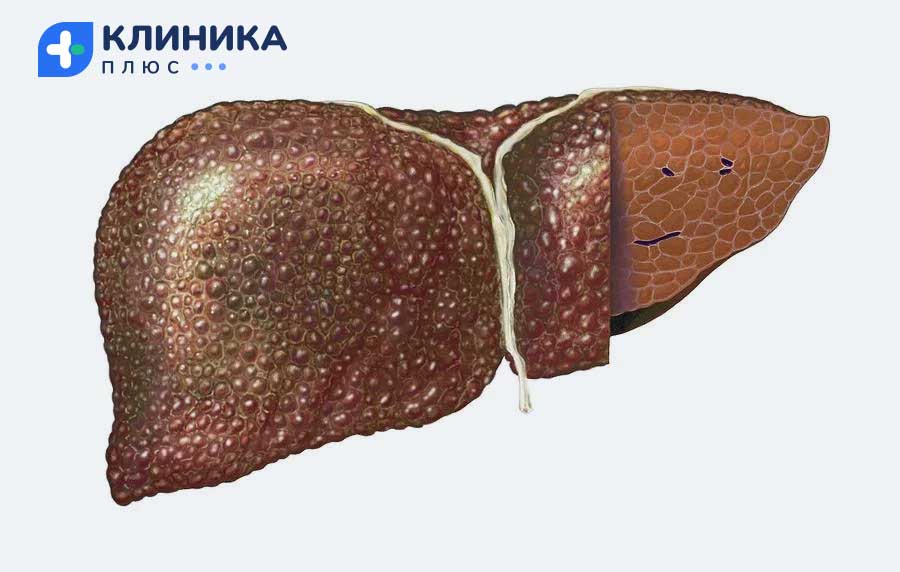 Печень, покрытая коркой и волдырями
